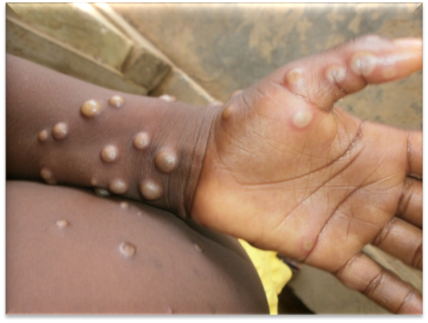 원숭이두창에 특징적으로 나타나는 수포성 피부병변. 사진=세계보건기구 제공