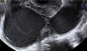 자궁내막증 초음파. 사진=국민건강보험공단 제공